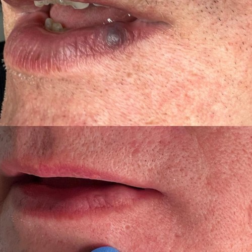 Laser żółty - dwóch fal - Małgorzata Grabowska-Olejarczyk, Dermatolog Kielce - Naczyniaki
