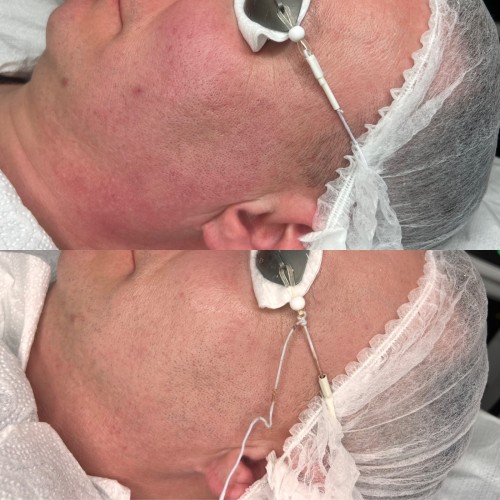 Laser żółty - dwóch fal - Małgorzata Grabowska-Olejarczyk, Dermatolog Kielce - Rumień