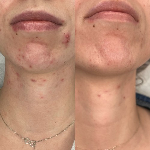 Laser żółty - dwóch fal - Małgorzata Grabowska-Olejarczyk, Dermatolog Kielce - Trądzik opóźniony hormonalny