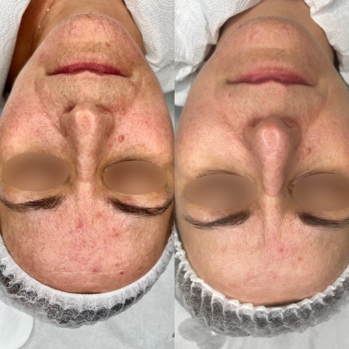 Laser żółty - dwóch fal - Małgorzata Grabowska-Olejarczyk, Dermatolog Kielce - Trądzik różowaty