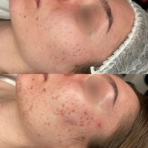 Laser żółty - dwóch fal - Małgorzata Grabowska-Olejarczyk, Dermatolog Kielce - Trądzik młodzieńczy