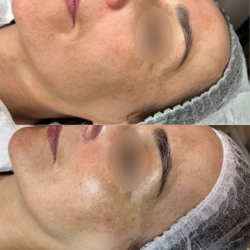 Laser żółty - dwóch fal - Małgorzata Grabowska-Olejarczyk, Dermatolog Kielce