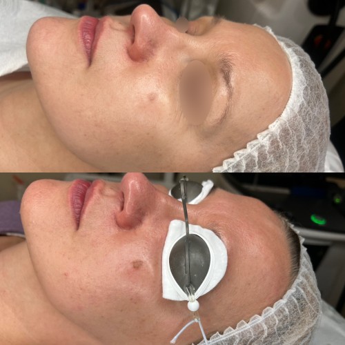 Laser żółty - dwóch fal - Małgorzata Grabowska-Olejarczyk, Dermatolog Kielce